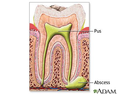 Tooth abscess Tooth abscess