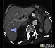 Adrenal metastases - CT scan Adrenal metastases - CT scan
