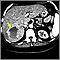 Hemangioma - CT scan Hemangioma - CT scan