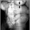 Ileus - X-ray of bowel distension Ileus - X-ray of bowel distension