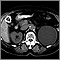 Kidney cyst with gallstones - CT scan Kidney cyst with gallstones - CT scan