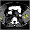 Spleen metastasis - CT scan Spleen metastasis - CT scan