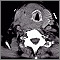 Thyroid cancer - CT scan Thyroid cancer - CT scan