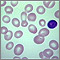 Megaloblastic anemia - view of red blood cells Megaloblastic anemia - view of red blood cells