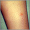 Chickenpox - lesion on the leg Chickenpox - lesion on the leg