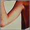 Rocky mountain spotted fever on the arm Rocky mountain spotted fever on the arm