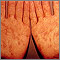 Syphilis - secondary on the palms Syphilis - secondary on the palms