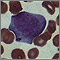 Mononucleosis - photomicrograph of cells Mononucleosis - photomicrograph of cells