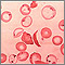 Red blood cells - sickle and Pappenheimer
