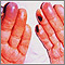 Cryoglobulinemia of the fingers Cryoglobulinemia of the fingers