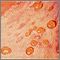 Bullous pemphigoid - close-up of tense blisters Bullous pemphigoid - close-up of tense blisters