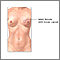 Breast reconstruction - series - Indication, part 1