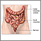 Colon cancer - Series Colon cancer - Series