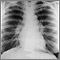 Sarcoid, stage I - chest X-ray Sarcoid, stage I - chest X-ray