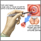 Cold cone biopsy Cold cone biopsy