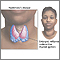 Hashimoto's disease (chronic thyroiditis) Hashimoto's disease (chronic thyroiditis)