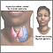 Goiter Goiter