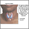 Hypothyroidism Hypothyroidism