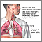 CMV pneumonia CMV pneumonia