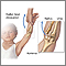 Radial head injury Radial head injury
