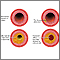 Developmental process of atherosclerosis Developmental process of atherosclerosis