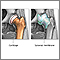 Osteoarthritis vs. rheumatoid arthritis Osteoarthritis vs. rheumatoid arthritis