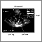 Ultrasound, normal fetus - ventricles of brain