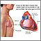 Pericarditis post-IM Pericarditis post-IM