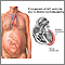 Peripartum cardiomyopathy Peripartum cardiomyopathy