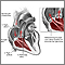 Tricuspid Regurgitation Tricuspid Regurgitation