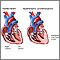 Hypertrophic cardiomyopathy Hypertrophic cardiomyopathy