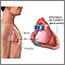 Pericarditis Pericarditis