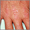 Dermatomyositis - Gottron's papules on the hand