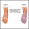 Diabetic blood circulation in foot