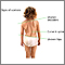 Signs of scoliosis Signs of scoliosis