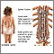 Spinal fusion Spinal fusion