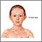 Chickenpox Chickenpox