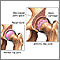 Arthritis in hip Arthritis in hip