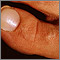 White nail syndrome White nail syndrome