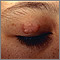 Granuloma annulare on the eyelid Granuloma annulare on the eyelid