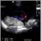 Ultrasound, color - normal umbilical cord Ultrasound, color - normal umbilical cord