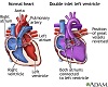 Double inlet left ventricle Double inlet left ventricle