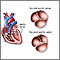 Bicuspid aortic valve Bicuspid aortic valve