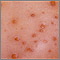 Chickenpox - close-up Chickenpox - close-up