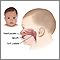 Cleft lip repair - series Cleft lip repair - series