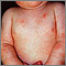 Dermatitis - atopic in an infant