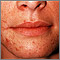 Perioral dermatitis Perioral dermatitis