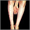 Dermatitis - herpetiformis on the arm and legs Dermatitis - herpetiformis on the arm and legs