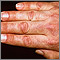 Dermatomyositis - Gottron papule