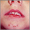Impetigo on a child's face